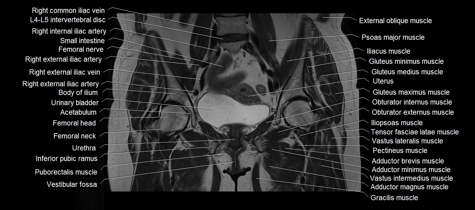 MRI 3T pelvis coronal cross section anatomy image 12.webp